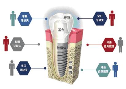 种植牙