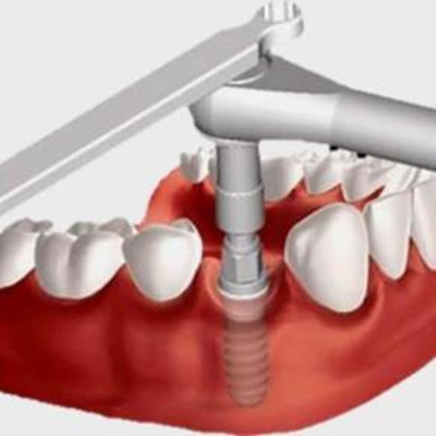 种植牙术后的护理方法