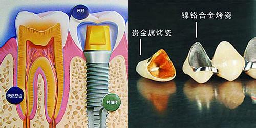 一般镶牙的种类有哪些