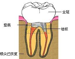 根管治疗后为什么要套上牙套